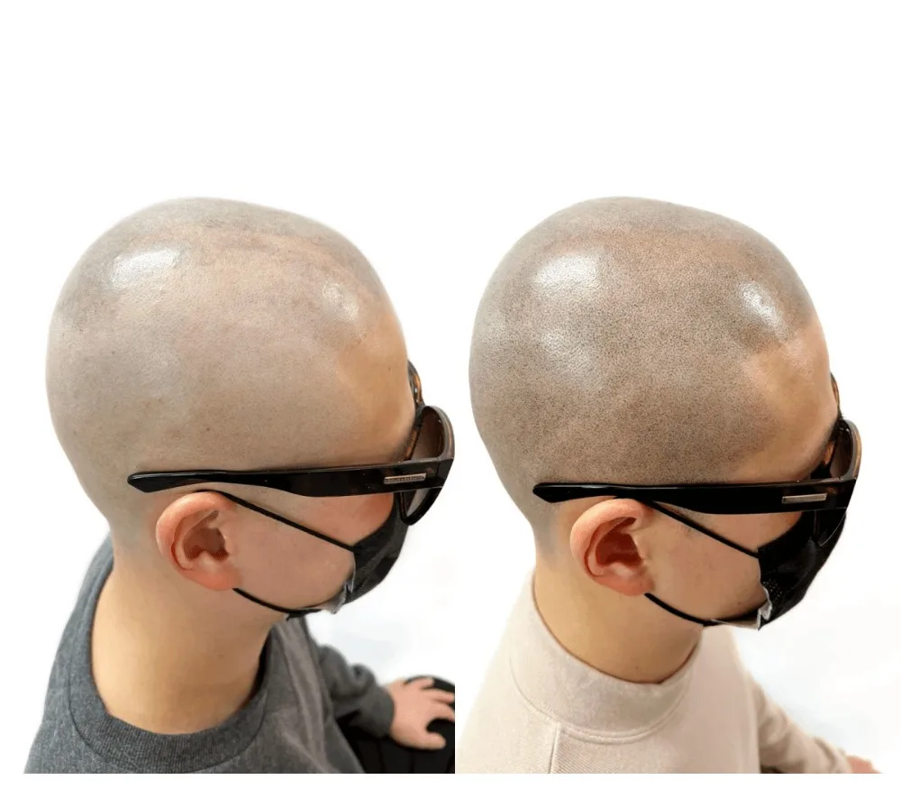 O자탈모 + 밀도보강 후 케이스 복구작업