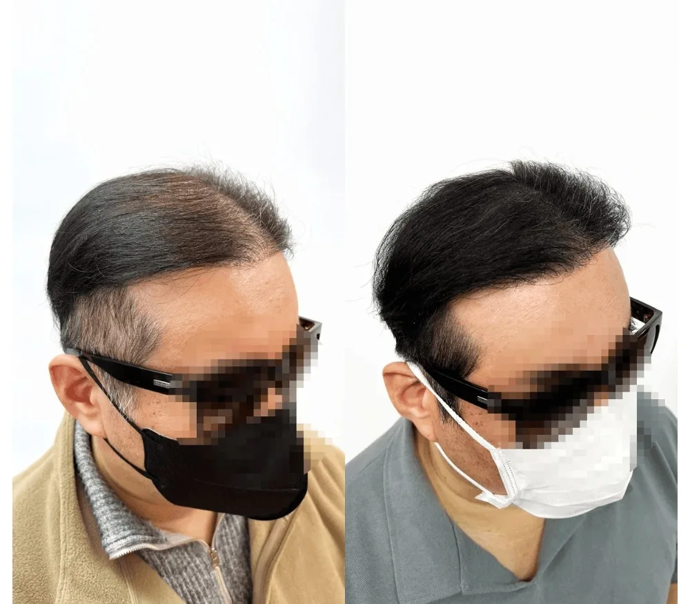 2회의 모발이식수술 후 케이스