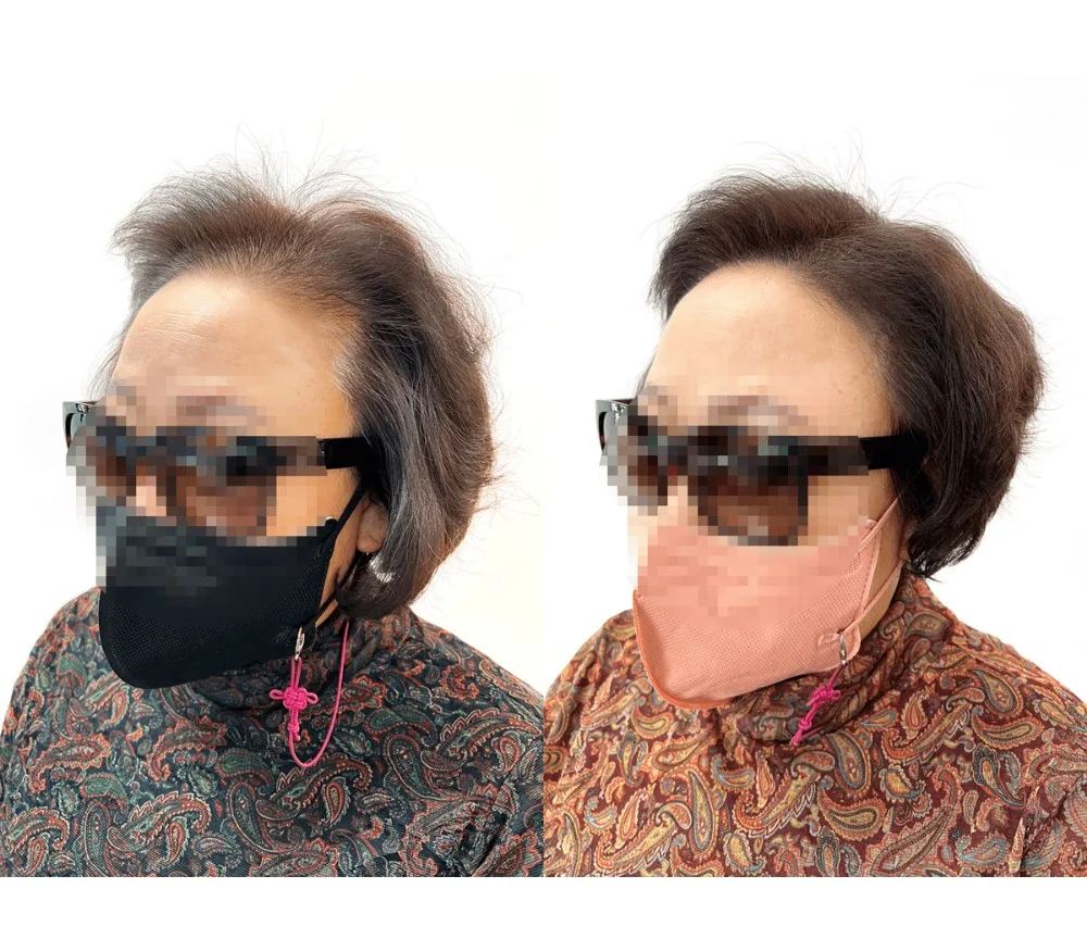 헤어라인, 가르마, 정수리