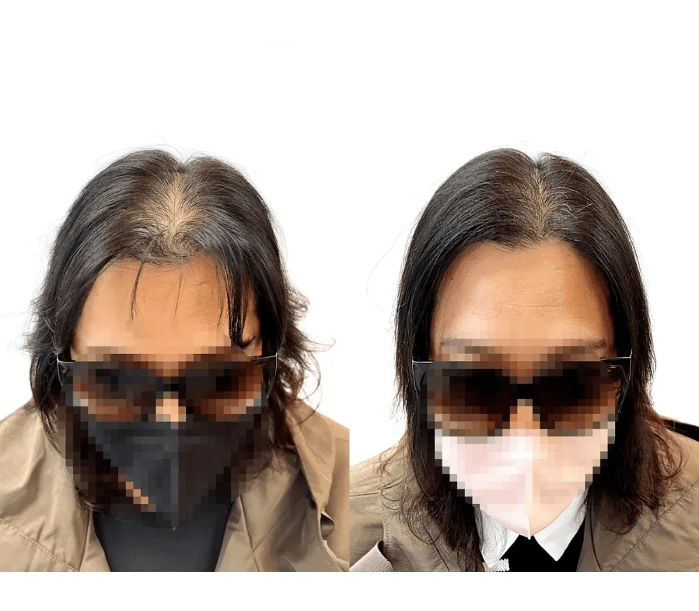 헤어라인, 가르마, 정수리