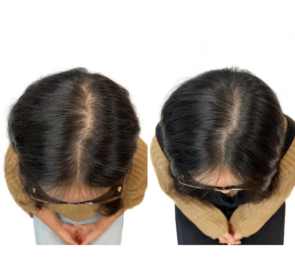 헤어라인, 가르마, 정수리